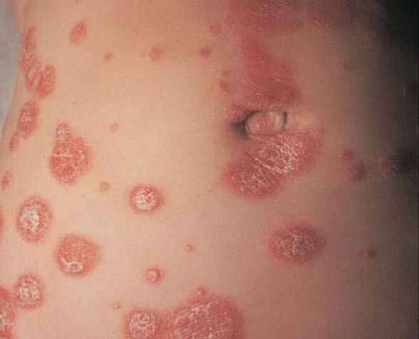 Red borders around the papules
