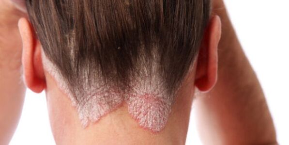 Scalp papules are clearly identified