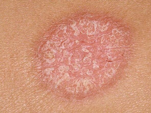Static stage of papules