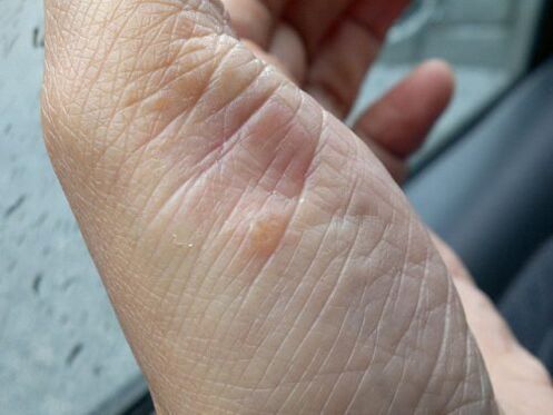 image of psoriasis on hand