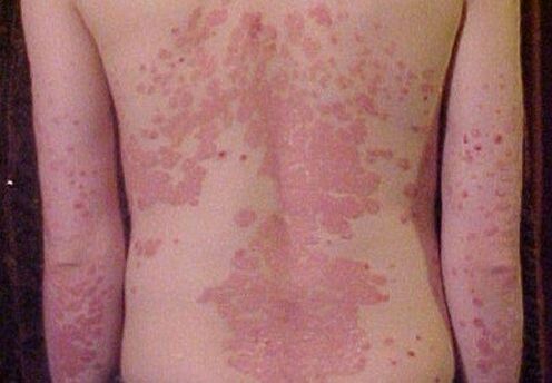 psoriasis symptoms in the back