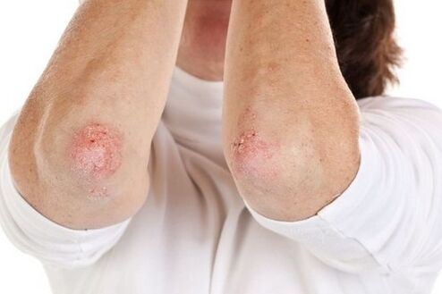 Manifestations of psoriasis in the elbow