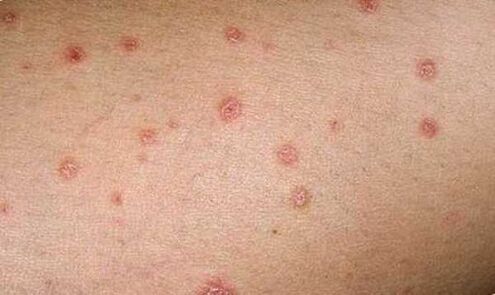 manifestation of the first stage of psoriasis on the skin
