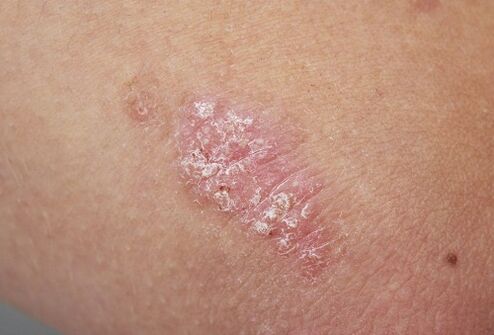 psoriatic patches on the skin