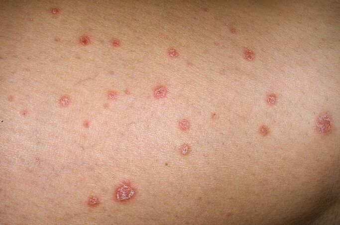 photo of the first symptoms of psoriasis