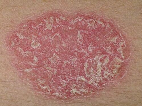 what a psoriasis looks like