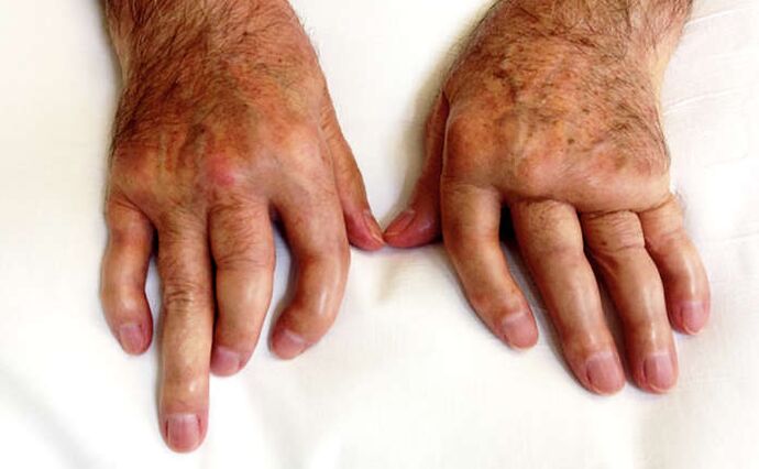 Causes changes in arthritis in psoriasis