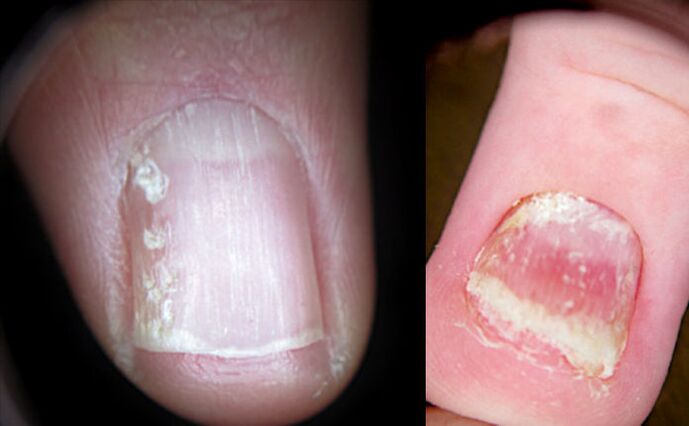Cracked nails caused by psoriasis
