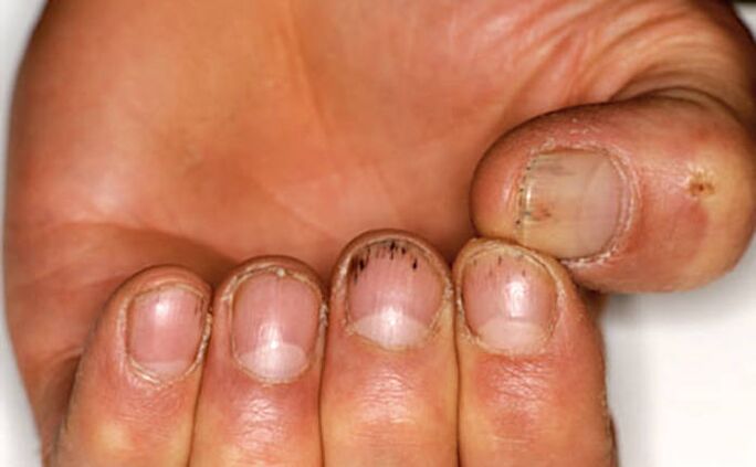 Hemorrhage under the nail with psoriasis