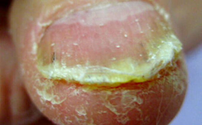 Hyperkeratosis under the skin in the thumb
