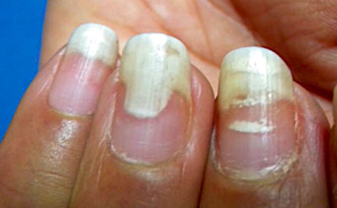 Onychomycosis and leukocytes after a manicure