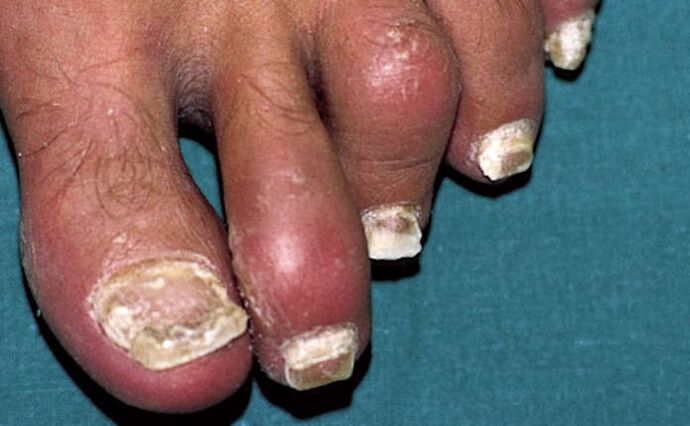 Psoriasis is related to the nail and arthritis (arthritis) of the toe