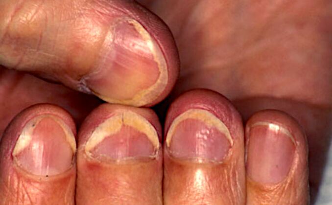 Scarlet fever at the edge of onychomycosis