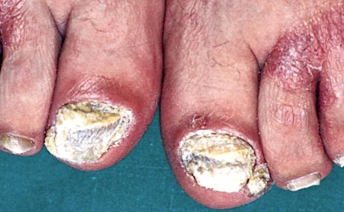 Severe hyperkeratosis under the skin and psoriatic plaques on the toes