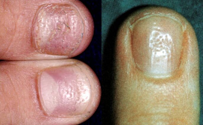 Shivering symptom - multiple indentations in the nail bed