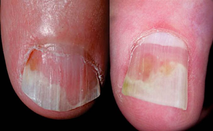 Signs of oil stains - salmon-colored areas near onychomycosis