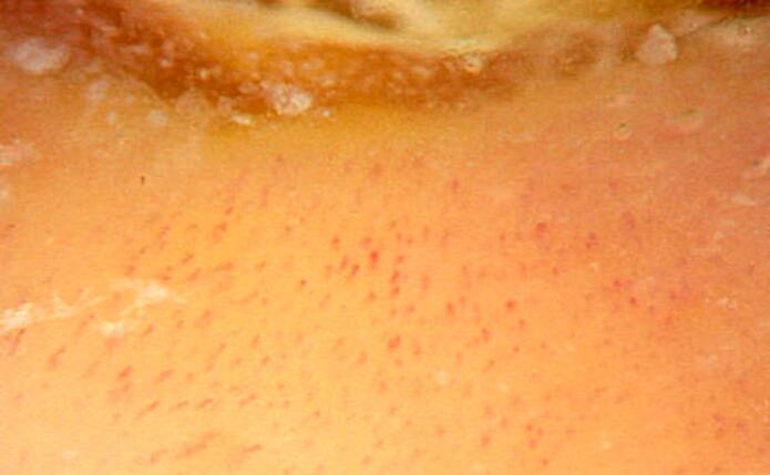 Skin microscopy with 40x magnification confirms psoriasis