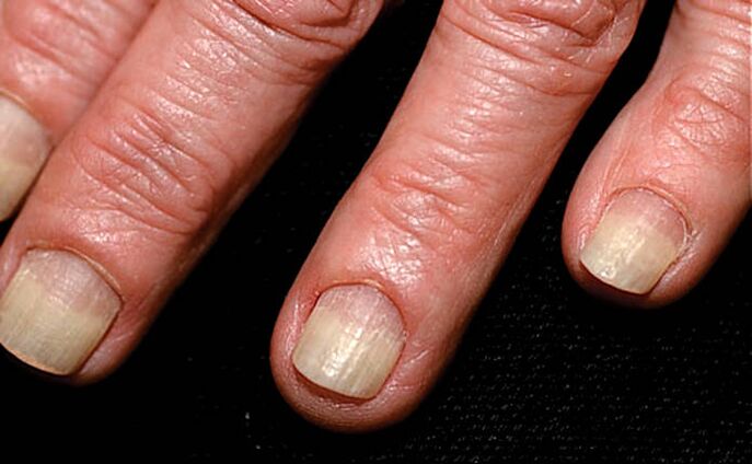 The spread of onychomycosis from the margin of the nail to the nail folds