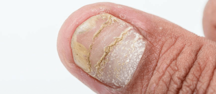 Acute complications of nail psoriasis