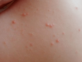 Identify symptoms of psoriasis rash