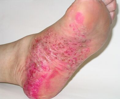 Psoriasis on the legs