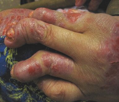 psoriasis on neglected hands