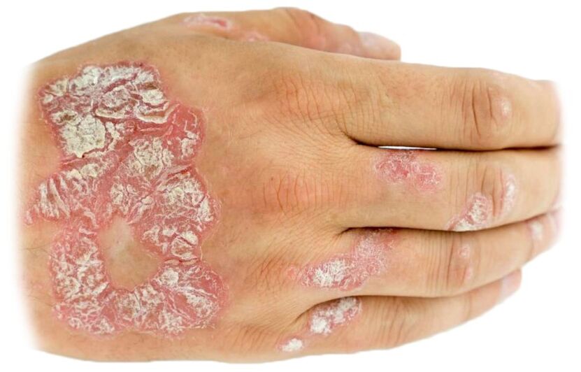 development of psoriasis